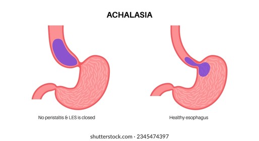 Esophageal achalasia medical poster. Failure of smooth muscle fibers to relax. Gastrointestinal tract disease. Closed lower esophageal sphincter, digestive system disorder flat vector illustration.