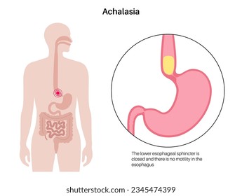 Afiche médico sobre la achalasia esofágica. Fallo de las fibras musculares lisas para relajarse. Enfermedad del tracto gastrointestinal. Esfínter esofágico inferior cerrado, desorden del sistema digestivo, ilustración vectorial plana.