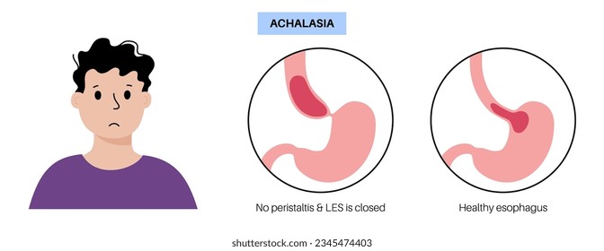 Esophageal achalasia medical poster. Failure of smooth muscle fibers to relax. Gastrointestinal tract disease. Closed lower esophageal sphincter, digestive system disorder flat vector illustration.