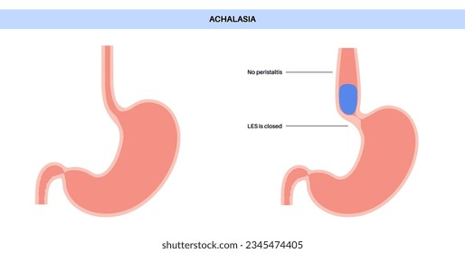 Esophageal achalasia medical poster. Failure of smooth muscle fibers to relax. Gastrointestinal tract disease. Closed lower esophageal sphincter, digestive system disorder flat vector illustration.