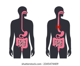 Esophageal achalasia medical poster. Failure of smooth muscle fibers to relax. Gastrointestinal tract disease. Closed lower esophageal sphincter, digestive system disorder flat vector illustration.