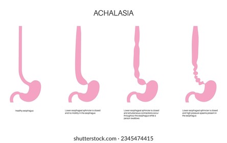 Esophageal achalasia medical poster. Failure of smooth muscle fibers to relax. Gastrointestinal tract disease. Closed lower esophageal sphincter, digestive system disorder flat vector illustration.