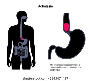 Esophageal achalasia medical poster. Failure of smooth muscle fibers to relax. Gastrointestinal tract disease. Closed lower esophageal sphincter, digestive system disorder flat vector illustration.