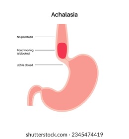 Esophageal achalasia medical poster. Failure of smooth muscle fibers to relax. Gastrointestinal tract disease. Closed lower esophageal sphincter, digestive system disorder flat vector illustration.