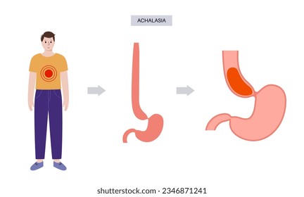 Esophageal achalasia medical poster. Failure of smooth muscle fibers to relax. Gastrointestinal tract disease. Closed lower esophageal sphincter, digestive system disorder flat vector illustration.