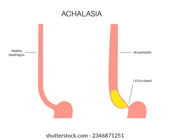 Esophageal achalasia medical poster. Failure of smooth muscle fibers to relax. Gastrointestinal tract disease. Closed lower esophageal sphincter, digestive system disorder flat vector illustration.