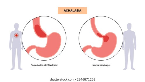 Esophageal achalasia medical poster. Failure of smooth muscle fibers to relax. Gastrointestinal tract disease. Closed lower esophageal sphincter, digestive system disorder flat vector illustration.