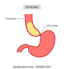 Esophageal achalasia medical poster. Failure of smooth muscle fibers to relax. Gastrointestinal tract disease. Closed lower esophageal sphincter, digestive system disorder flat vector illustration.