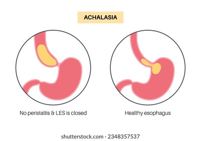 Esophageal achalasia medical poster. Failure of smooth muscle fibers to relax. Gastrointestinal tract disease. Closed lower esophageal sphincter, digestive system disorder flat vector illustration.