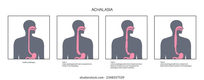 Esophageal achalasia medical poster. Failure of smooth muscle fibers to relax. Gastrointestinal tract disease. Closed lower esophageal sphincter, digestive system disorder flat vector illustration.