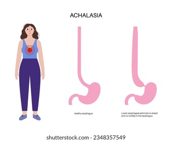 Esophageal achalasia medical poster. Failure of smooth muscle fibers to relax. Gastrointestinal tract disease. Closed lower esophageal sphincter, digestive system disorder flat vector illustration.