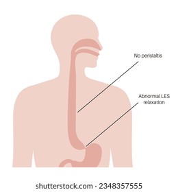 Esophageal achalasia medical poster. Failure of smooth muscle fibers to relax. Gastrointestinal tract disease. Closed lower esophageal sphincter, digestive system disorder flat vector illustration.