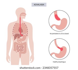 Afiche médico sobre la achalasia esofágica. Fallo de las fibras musculares lisas para relajarse. Enfermedad del tracto gastrointestinal. Esfínter esofágico inferior cerrado, desorden del sistema digestivo, ilustración vectorial plana.