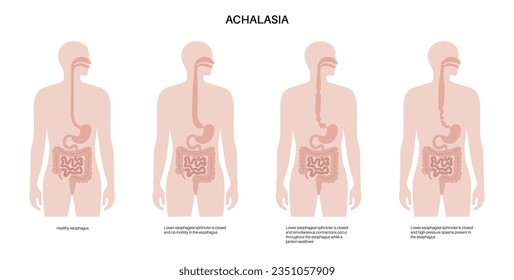 Esophageal achalasia medical poster. Failure of smooth muscle fibers to relax. Gastrointestinal tract disease. Closed lower esophageal sphincter, digestive system disorder flat vector illustration.