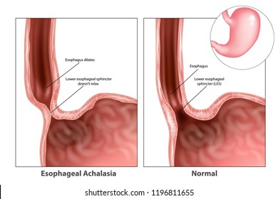 Esophageal achalasia, often called simple achalasia. Lower esophageal sphincter doesn’t relax.