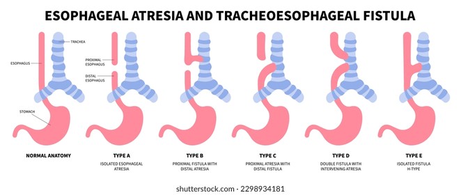 esophageal atresia tracheoesophageal fistula of baby and newborn infant pylorus disease pain