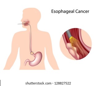 Esophageal Cancer