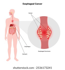 Esophageal cancer disease malignant cancer cells form in the tissues of the esophagus