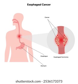 Esophageal cancer disease malignant cancer cells form in the tissues of the esophagus