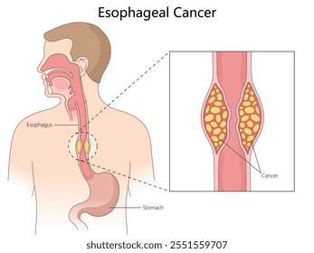 esophageal cancer, highlighting the affected esophagus area with a close-up of tumor cells diagram hand drawn schematic vector illustration. Medical science educational illustration