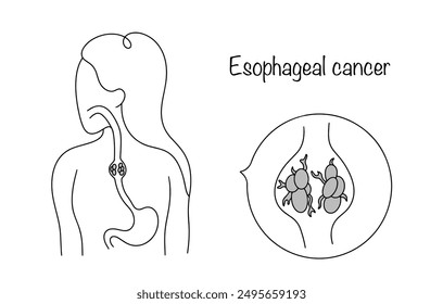 Esophageal cancer. An oncological disease in which a tumor grows from the walls of the esophagus. An illustration showing a cancerous tumor in the human esophagus.