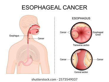 Esophageal cancer. Transverse section and Coronal section of Esophagus. Adenocarcinoma. Close-up of a Esophageal Lumen. Human silhouette with stomach, throat and oesophagus. Vector illustration. poste