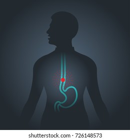 Esophageal Cancer Vector Logo Icon Illustration