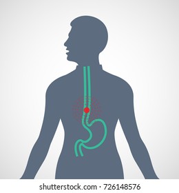 Esophageal Cancer Vector Logo Icon Illustration