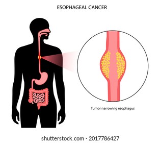 Esophageal carcinoma. Esophagus, intestine and stomach in the male body. Inflammation, pain, tumor in human digestive system. Internal organs exam concept. Oesophagus cancer flat vector illustration