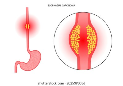 Esophageal Carcinoma. Esophagus And Stomach Anatomical Icons. Inflammation, Pain, Tumor In The Human Digestive System. Internal Organs Exam Concept. Oesophagus Cancer. Medical Flat Vector Illustration