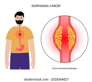 Esophageal Carcinoma. Esophagus And Stomach Anatomy In The Male Body. Inflammation, Pain, Tumor In Human Digestive System. Internal Organs Exam Concept. Oesophagus Cancer Flat Vector Illustration.