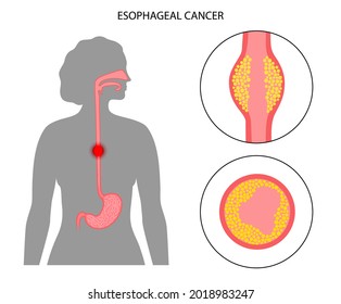 Esophageal Carcinoma. Esophagus And Stomach Anatomy In The Female Body. Inflammation, Pain, Tumor In Human Digestive System. Internal Organs Exam Concept. Oesophagus Cancer Flat Vector Illustration.