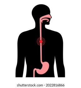 Esophageal carcinoma. Esophagus and stomach anatomy in the male body. Inflammation, pain, tumor in human digestive system. Internal organs exam concept. Oesophagus cancer flat vector illustration.