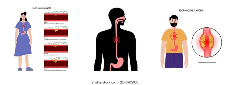 Esophageal Carcinoma. Esophagus And Stomach Anatomy In The Female Body. Inflammation, Pain, Tumor In Human Digestive System. Internal Organs Exam Concept. Oesophagus Cancer Flat Vector Illustration.