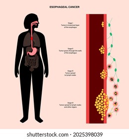 Esophageal Carcinoma Stages. Esophagus And Stomach Anatomy In The Female Body. Inflammation, Pain, Tumor In Human Digestive System. Internal Organs Exam. Oesophagus Cancer Flat Vector Illustration..