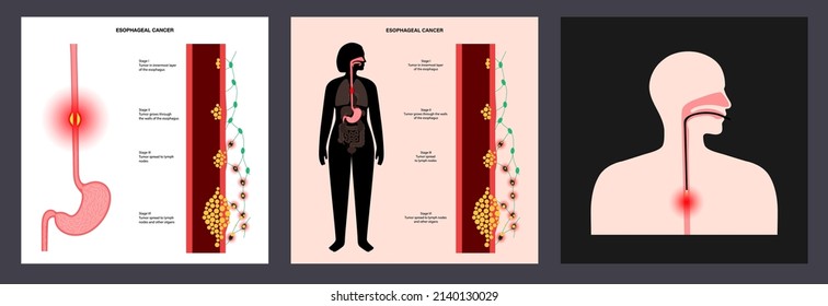 Esophageal Carcinoma Stages. Esophagus And Stomach Anatomy In The Female Body. Inflammation, Pain, Tumor In Human Digestive System. Internal Organs Exam. Oesophagus Cancer Flat Vector Illustration.