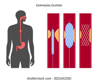 Esophageal dilation procedure. Esophagus and stomach disease, angioplasty and stent placement. Balloon snanting in the human internal organs. Digestive system illness. Medical flat vector illustration