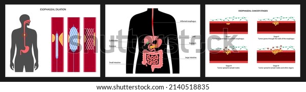 Esophageal dilation procedure. Esophagus and\
stomach disease, angioplasty and stent placement. Balloon snanting\
in the human internal organs. Digestive system illness. Medical\
flat vector\
illustration