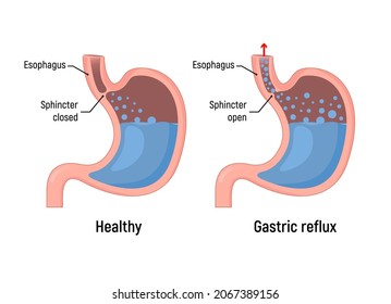 Esophageal Gastric Reflux Acid Indigestion. Gastrointestinal Stomach Heartburn Gerd Gastric Reflux