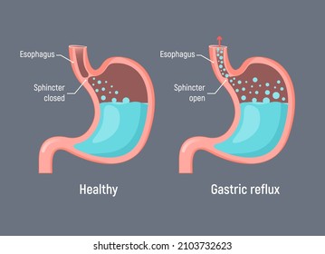 Esophageal Gastric Reflux Acid Indigestion. Gastrointestial Stomach Heartburn Gerd Gastric Reflux