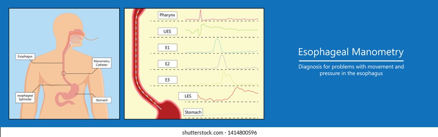 Esophageal Manometry Test Esophageal Diagnose Food High Resolution Impedance HRM Difficulty Swallowing Achalasia Treat Acid