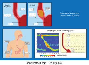 Esophageal Manometry Test Esophageal Diagnose Food High Resolution Impedance HRM Difficulty Swallowing Achalasia Treat Acid