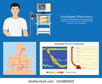 Esophageal Manometry Test Esophageal Diagnose Food High Resolution Impedance HRM Difficulty Swallowing Achalasia Treat Acid