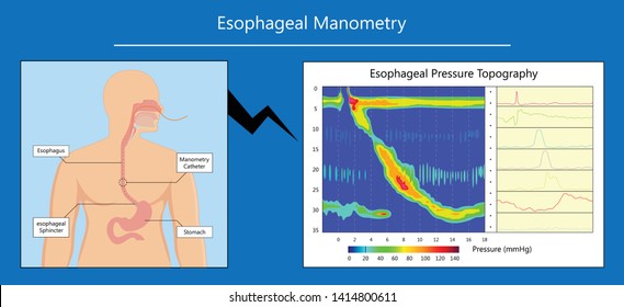 Esophageal Manometry Test Esophageal Diagnose Food High Resolution Impedance HRM Difficulty Swallowing Achalasia Treat Acid