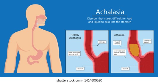 Esophageal Manometry Test Esophageal Diagnose Food High Resolution Impedance HRM Difficulty Swallowing Achalasia Treat Acid