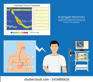 Esophageal Manometry Test Esophageal Diagnose Food High Resolution Impedance HRM Difficulty Swallowing Achalasia Treat Acid