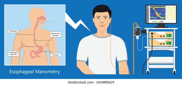 Esophageal Manometry Test Esophageal Diagnose Food High Resolution Impedance HRM Difficulty Swallowing Achalasia Treat Acid