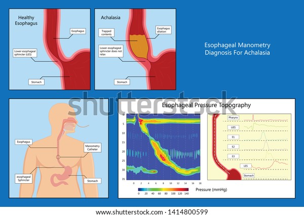 Esophageal Manometry Achalasia