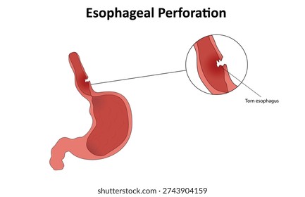 Esophageal perforation vector illustration. Ruptured esophagus