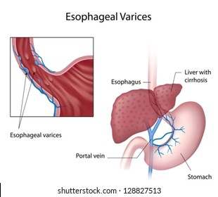 Esophageal Varices